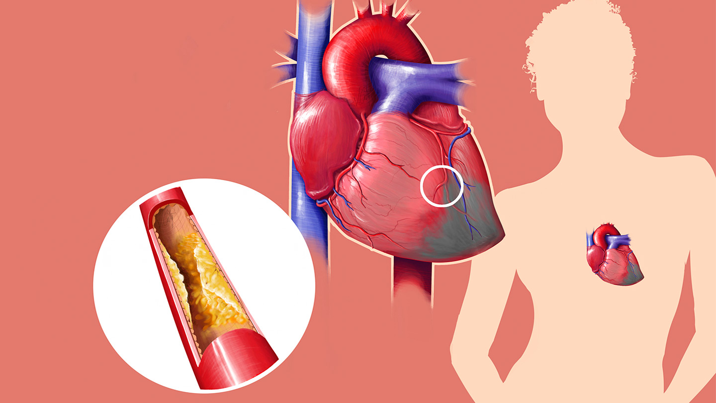 Facts about high cholesterol