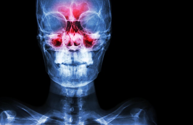 6 reasons why sinusitis can cause brain fog 