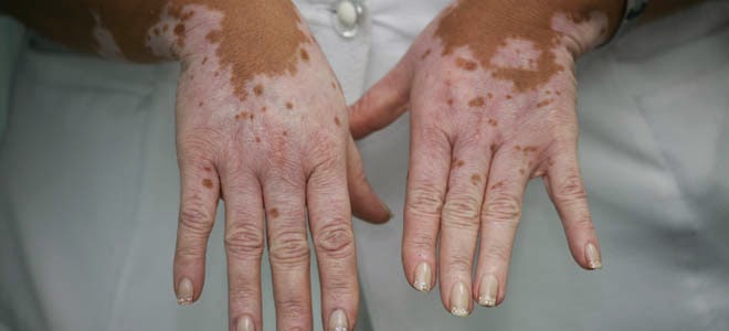 El mundo entero celebra esta noticia:Médicos logran cura para el vitiligo