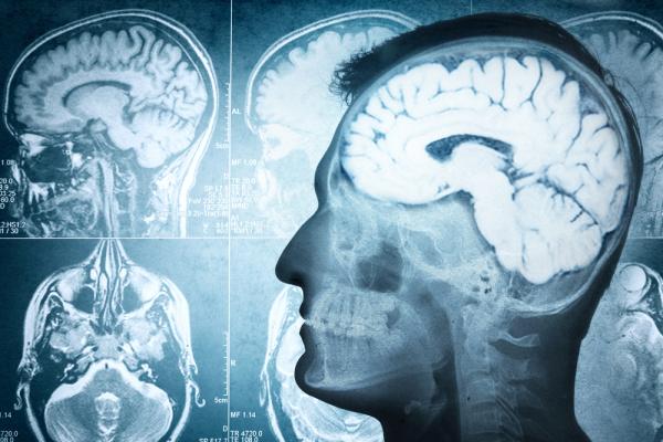 Hyperactive brain networks can multiply fibromyalgia pain: Study